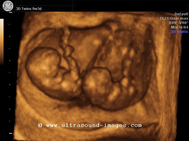 12 Weeks Pregnant Pictures 3d Ultrasound