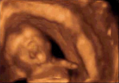 12 Weeks Pregnant Pictures 3d Ultrasound