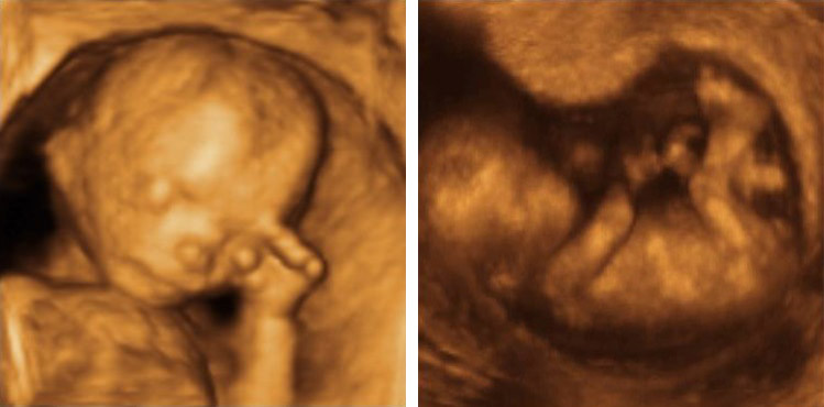 12 Weeks Pregnant Pictures 3d Ultrasound