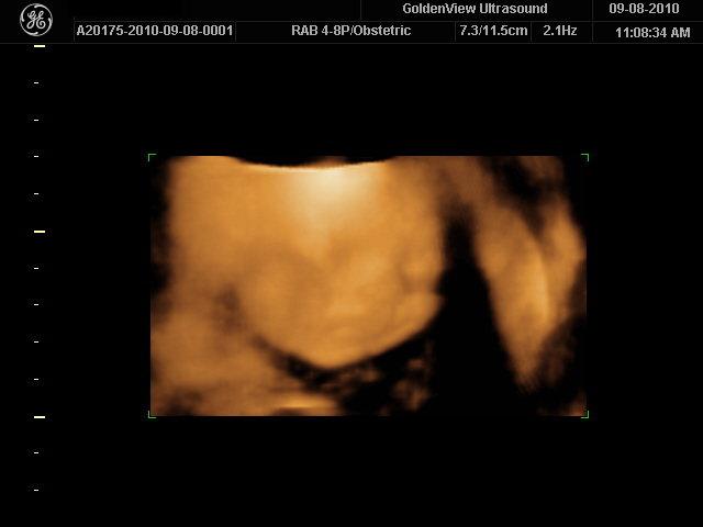 12 Weeks Pregnant Pictures 3d Ultrasound