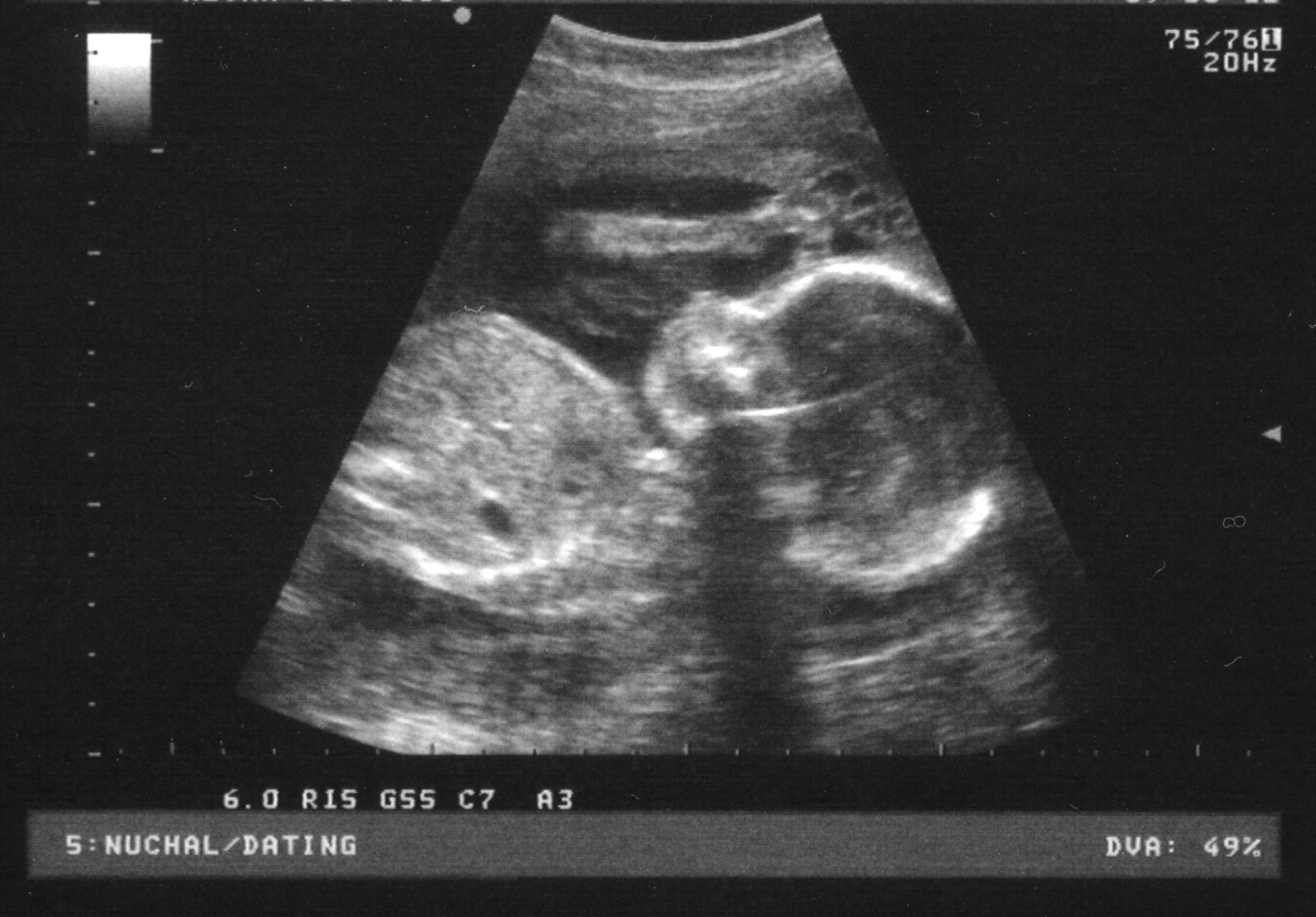 12 Weeks Pregnant Pictures Ultrasound