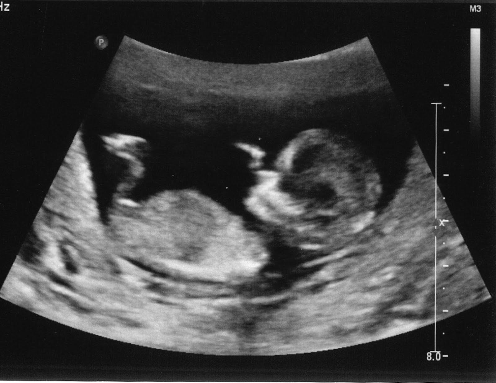 12 Weeks Pregnant Pictures Ultrasound