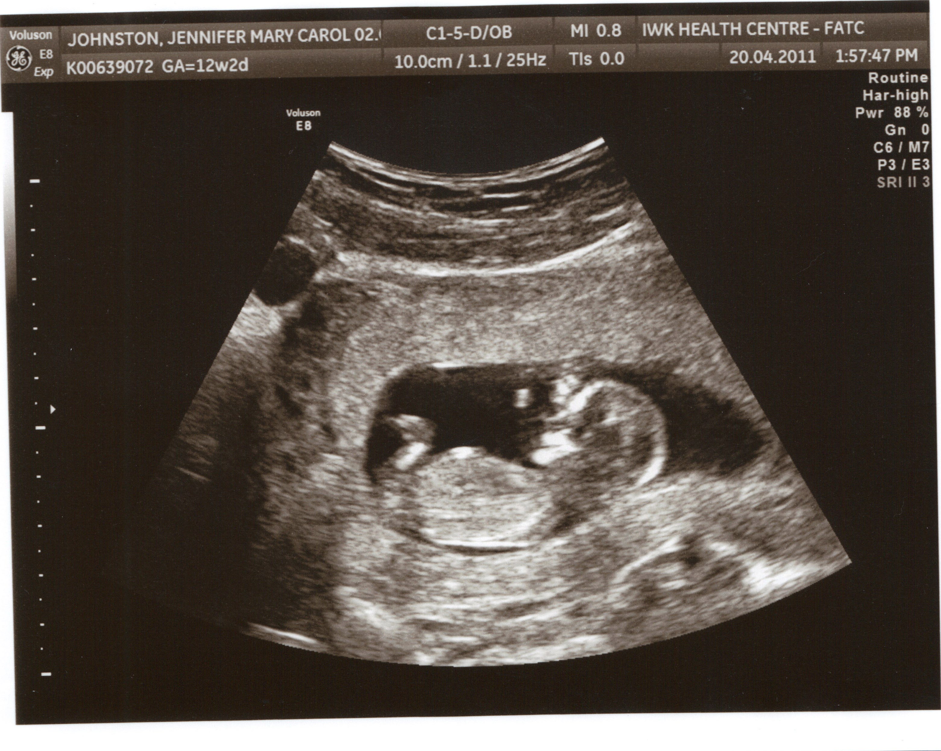 12 Weeks Pregnant Pictures Ultrasound