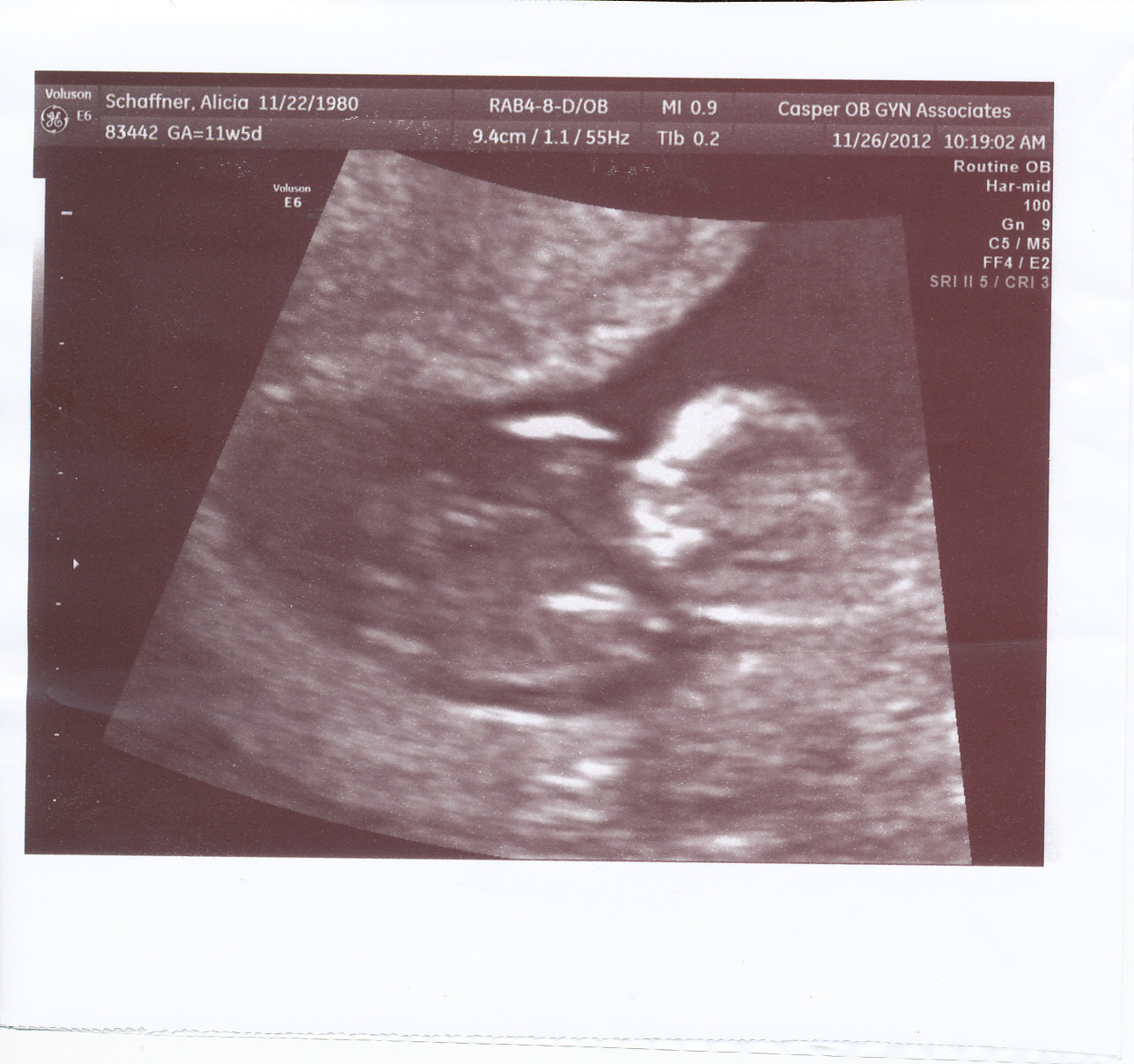 12 Weeks Pregnant Pictures Ultrasound