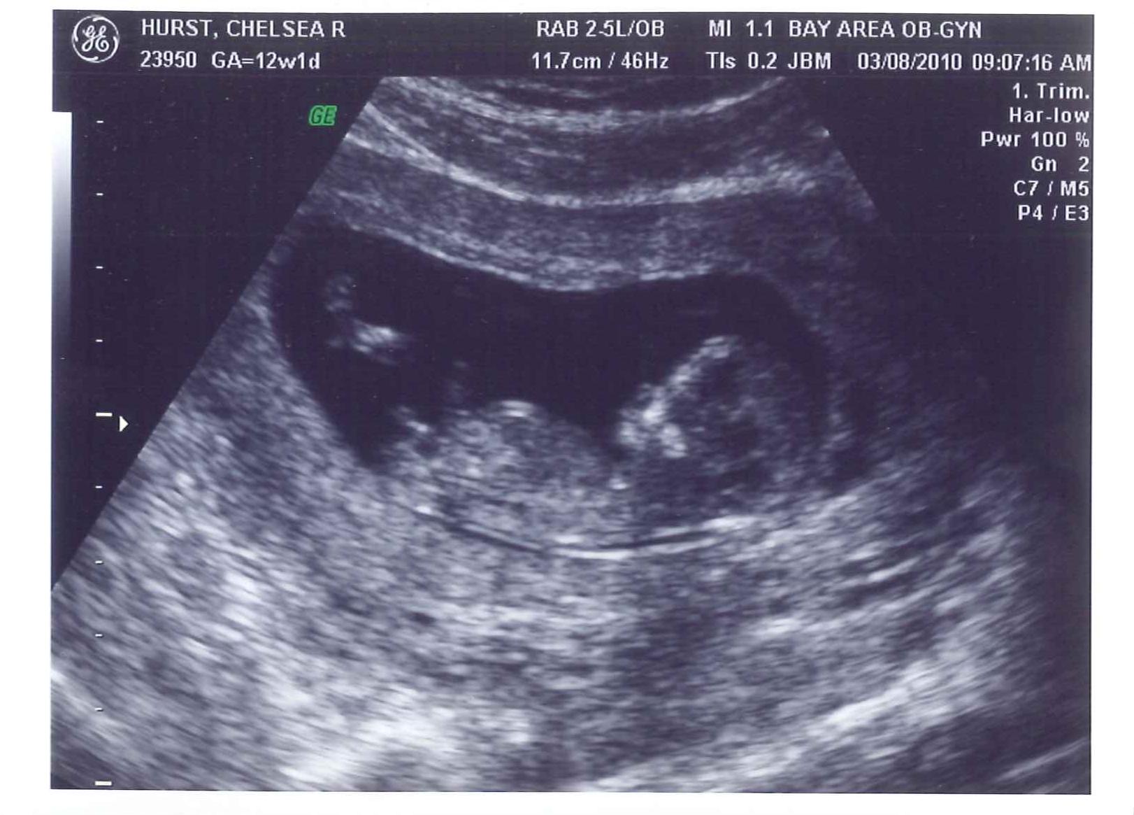 12 Weeks Pregnant Pictures Ultrasound