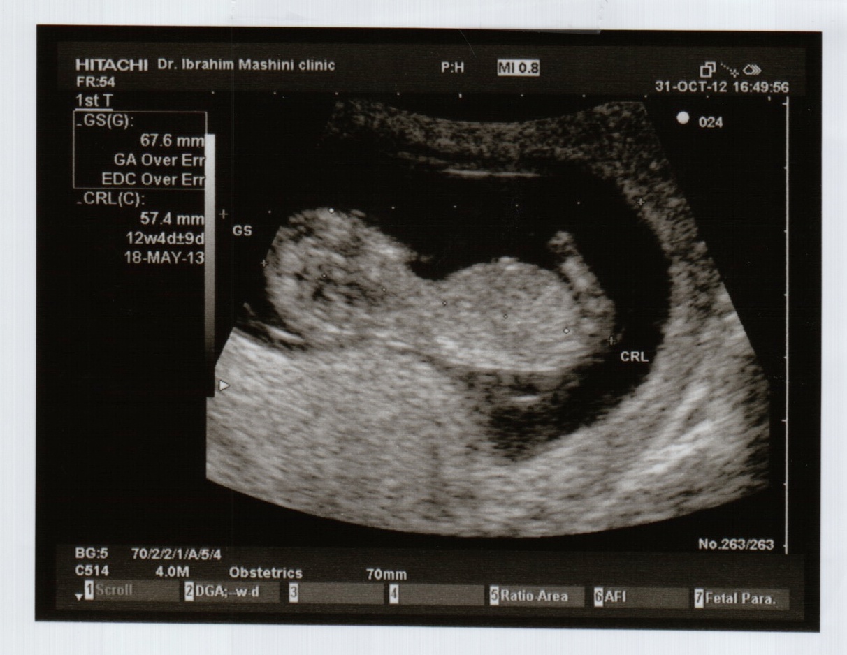 12 Weeks Pregnant Pictures Ultrasound