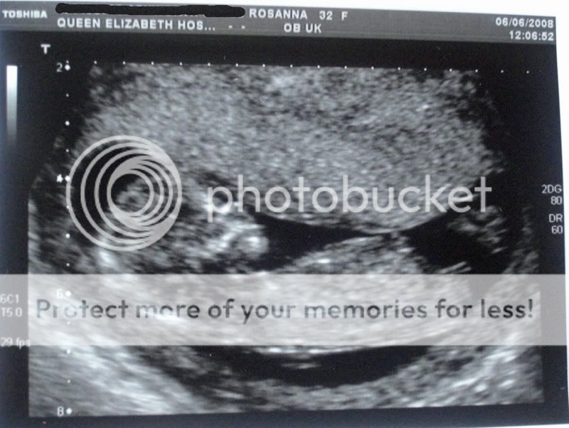 12 Weeks Pregnant Scan