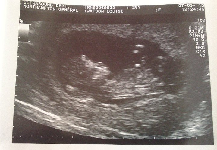 12 Weeks Pregnant Scan Boy Or Girl