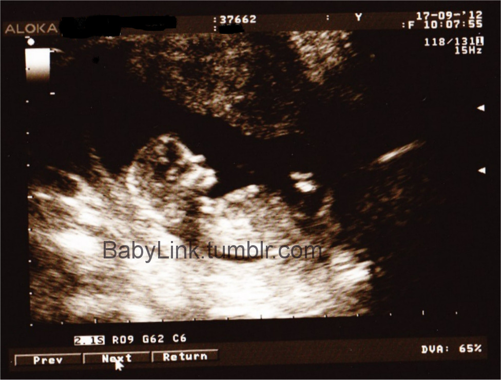 12 Weeks Pregnant Scan Boy Or Girl