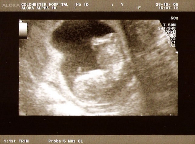 12 Weeks Pregnant Scan Twins