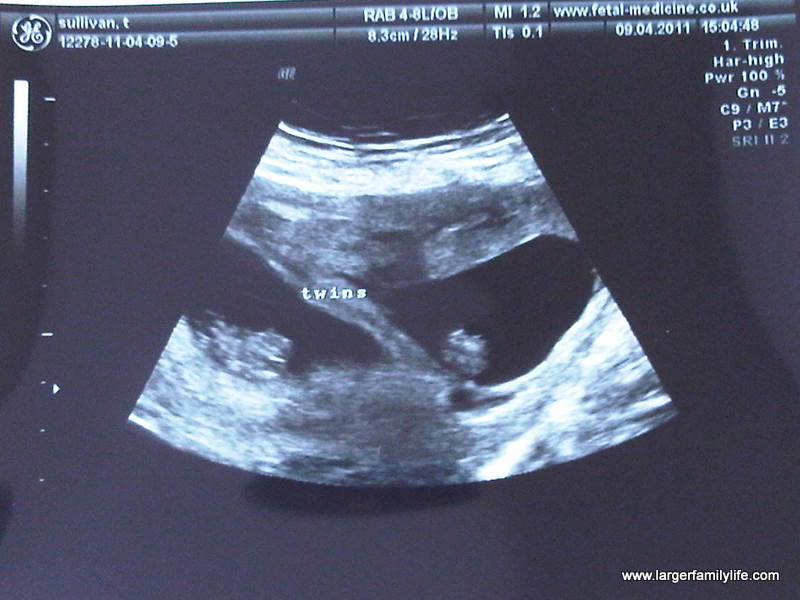 12 Weeks Pregnant Scan Twins