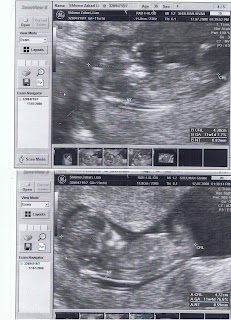 12 Weeks Pregnant Scan Twins