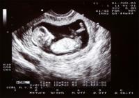 12 Weeks Pregnant Ultrasound