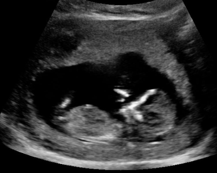 12 Weeks Pregnant Ultrasound