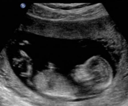 12 Weeks Pregnant Ultrasound