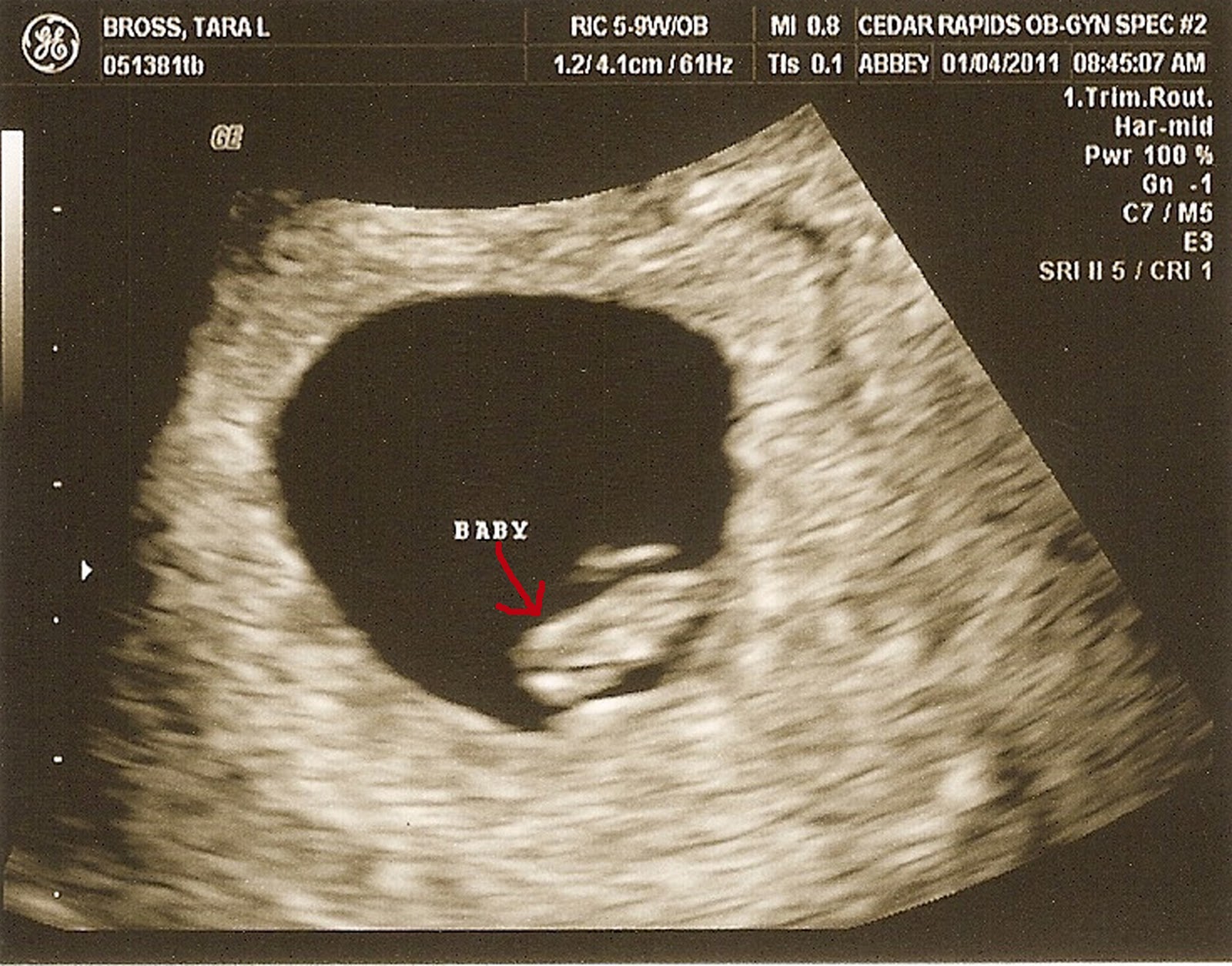 12 Weeks Pregnant Ultrasound Boy