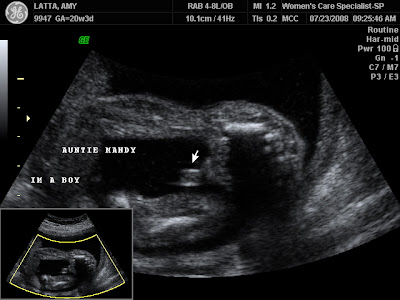 12 Weeks Pregnant Ultrasound Boy