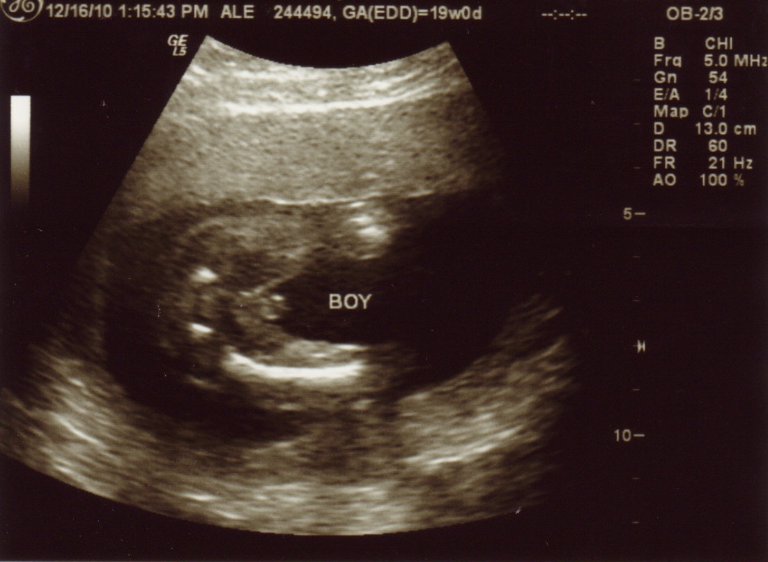 12 Weeks Pregnant Ultrasound Boy