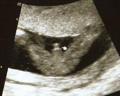 12 Weeks Pregnant Ultrasound Boy