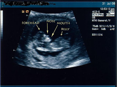 12 Weeks Pregnant Ultrasound Gender Determination