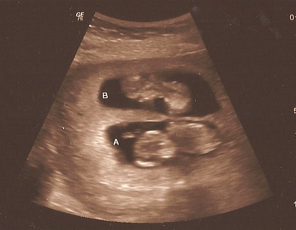 12 Weeks Pregnant Ultrasound Twins