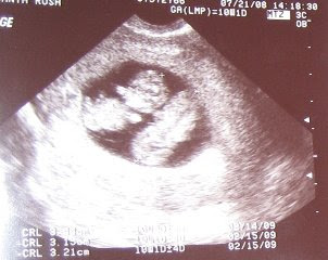 12 Weeks Pregnant Ultrasound Twins