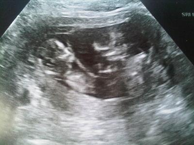 12 Weeks Pregnant Ultrasound Twins