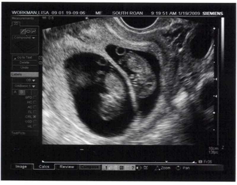 12 Weeks Pregnant Ultrasound Twins