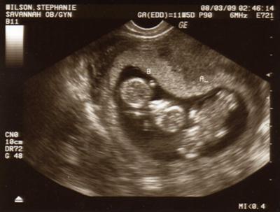 12 Weeks Pregnant Ultrasound Twins