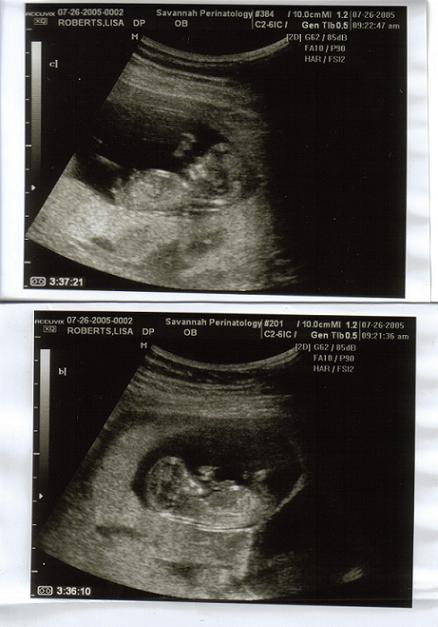 12 Weeks Pregnant With Twins