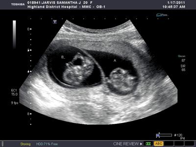 12 Weeks Pregnant With Twins