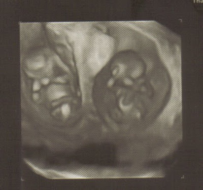 12 Weeks Pregnant With Twins Pictures