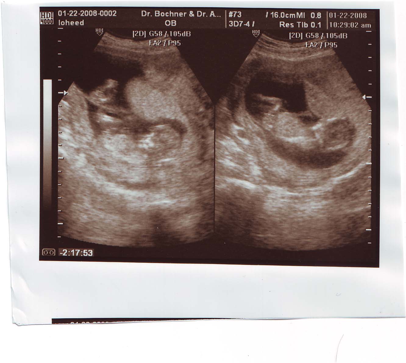 12 Weeks Pregnant With Twins Ultrasound