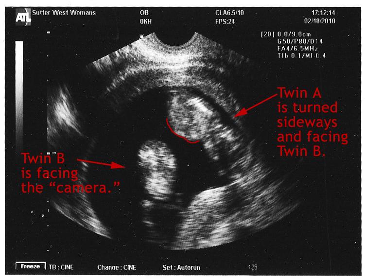 12 Weeks Pregnant With Twins Ultrasound