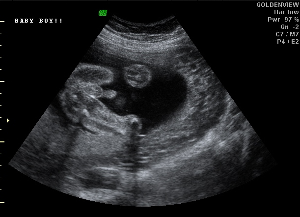 Gender 3d Ultrasound