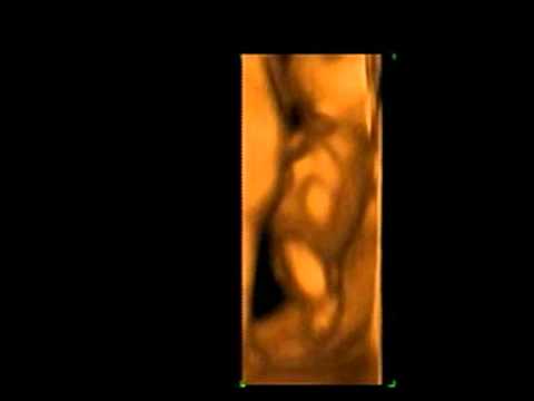 Gender 3d Ultrasound