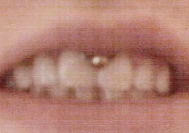 Smiley Piercing