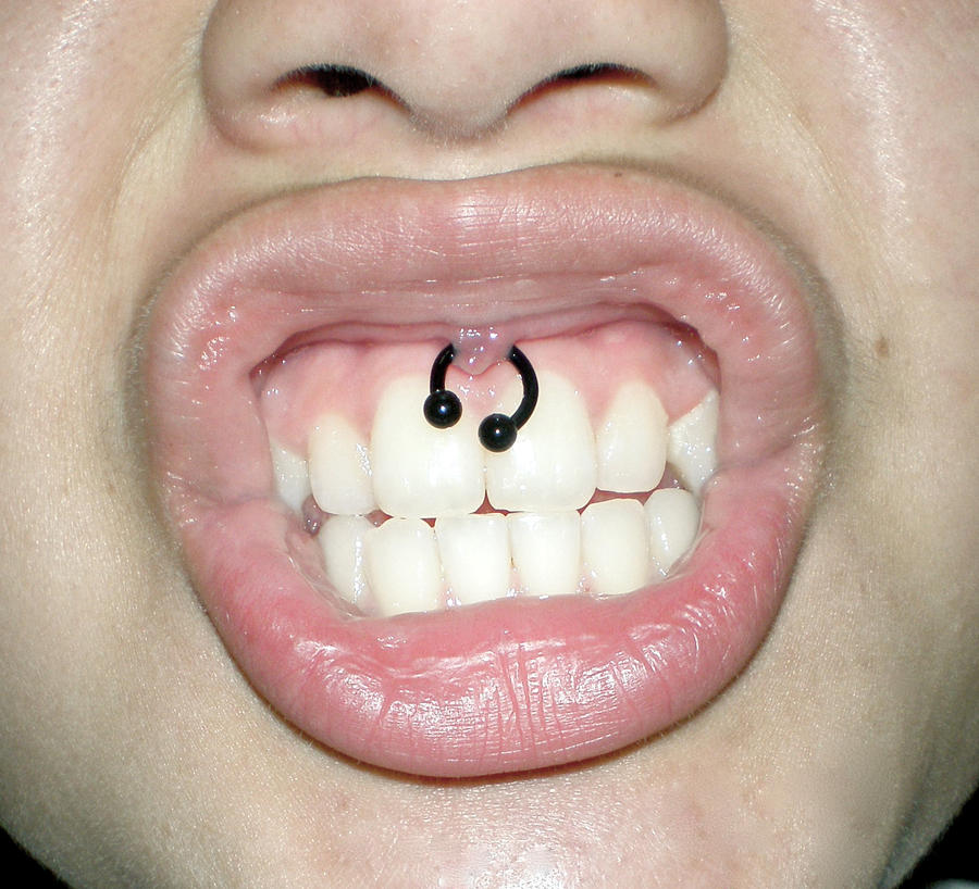 Smiley Piercing