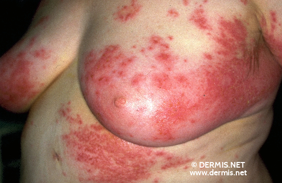 Allergic Contact Dermatitis Pictures