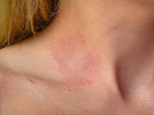 Allergic Contact Dermatitis Pictures