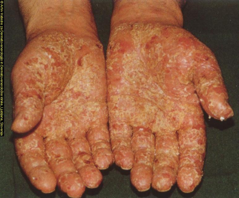 Allergic Contact Dermatitis Pictures