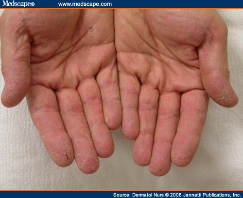 Allergic Contact Dermatitis Pictures