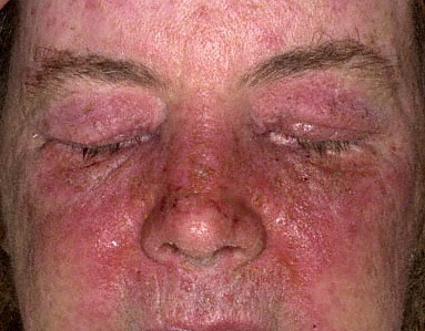 Allergic Contact Dermatitis Pictures