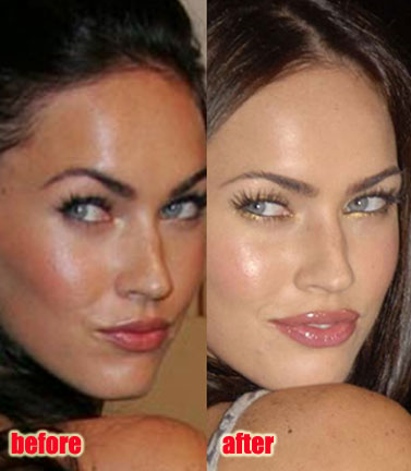 Angelina Jolie Lips Before After