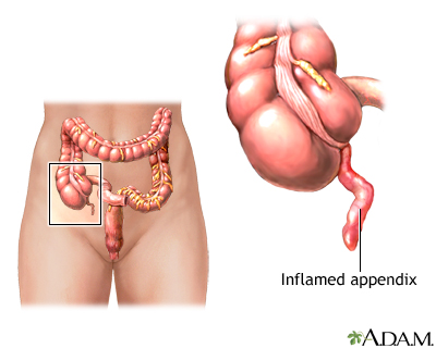 Appendix Burst Causes