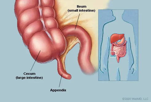 Appendix Burst In Children