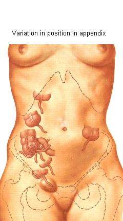 Appendix Location In Women