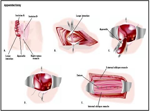 Appendix Location In Women