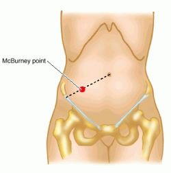 Appendix Location Pain