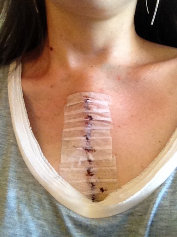 Appendix Operation Scar